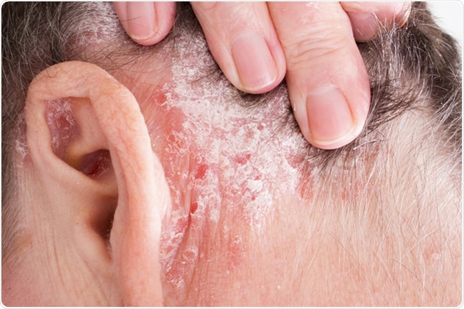 Psoriasis Vulgaris. Image Credit: Lipowski Milan / Shutterstock