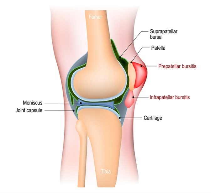 Bursitis. inflammation of bursae (synovial fluid). Image Credit: Designua / Shutterstock
