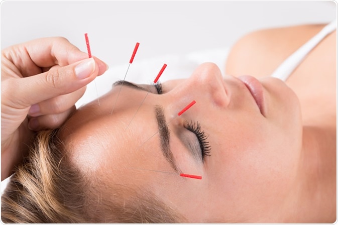 Closeup of hand performing acupuncture therapy on head at salon - Image Credit: Andrey_Popov / Shutterstock