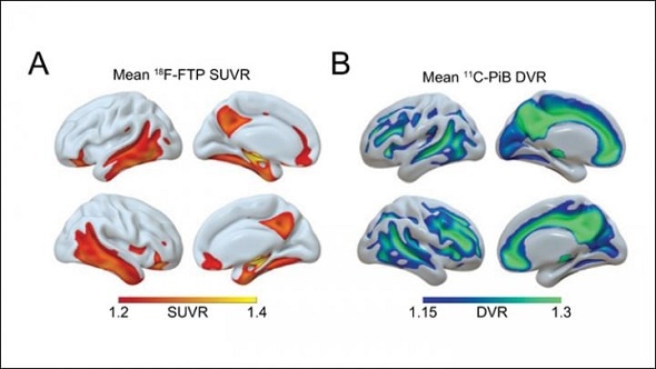 Sleep patterns can predict Alzheimer’s pathology later in life