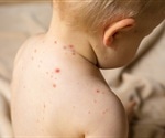 Pediatricians warn of measles resurgence and emphasize vaccine safety