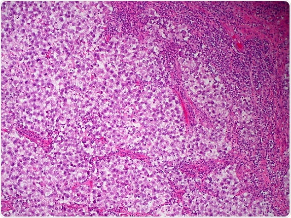 Study finds no increased risk of congenital anomalies in children of fathers treated for testicular cancer