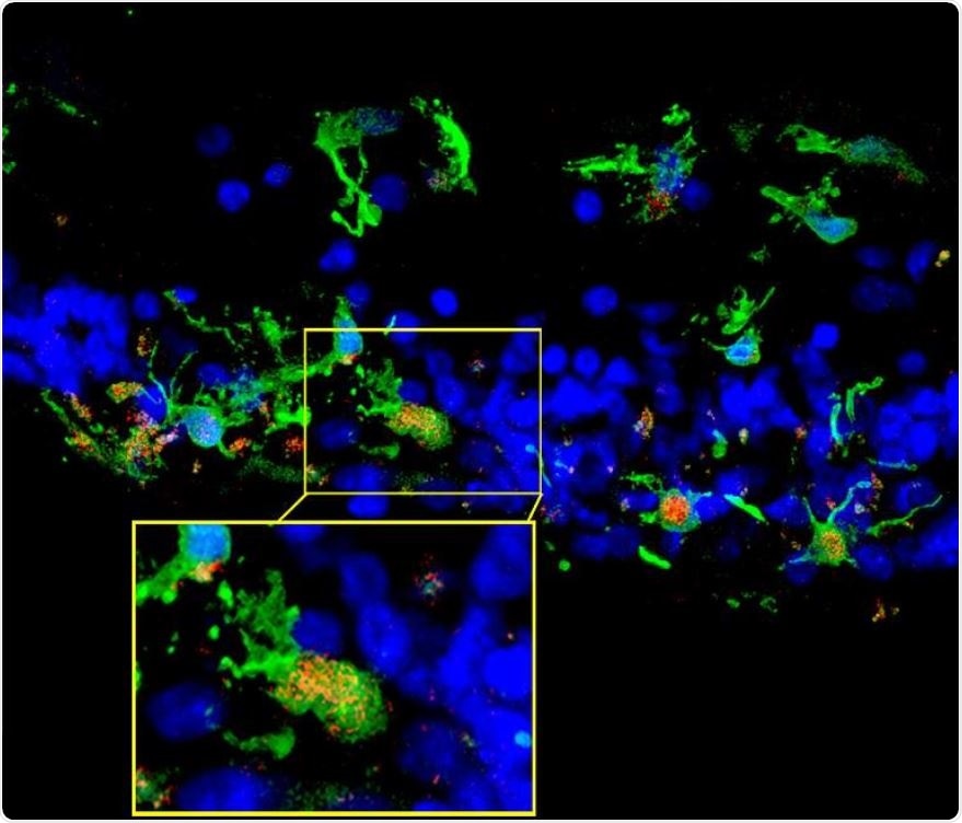 Retinal sections from a patient with retinitis pigmentosa show microglia (green) migrating into the photoreceptor layer (blue) once degeneration had begun. Inset shows microglia expressing C3 (red), which occurred in the context of photoreceptor degeneration.