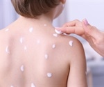 What is Chickenpox?
