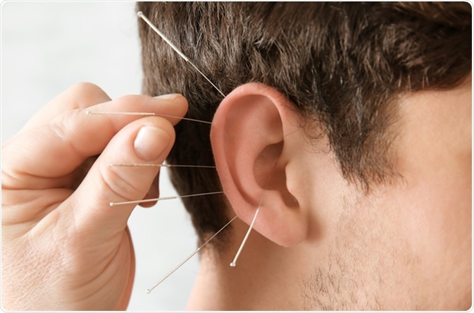 Acupuncture in man