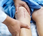 Pain After Knee Replacement Surgery