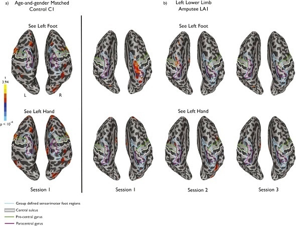 Research reveals how mirror therapy relieves phantom limb pain