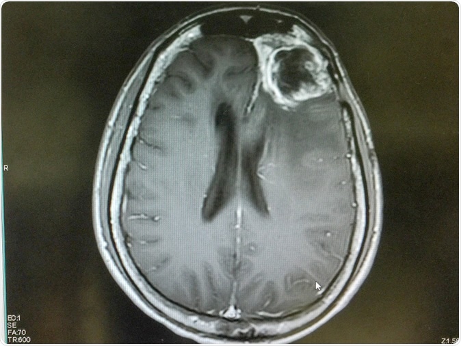 MRI brain show left frontal gliblastoma. Image Credit: O_Akira / Shutterstock