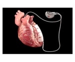 Implanted device uses microcurrent to exercise heart muscle in cardiomyopathy patients