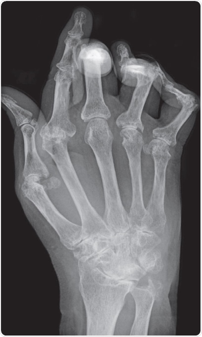 Typical X-ray of hand with advanced rheumatoid arthritis. Bone erosion, cartilage degradation and bone displacement are classic features of this disease (from Bernd Brägelmann via Wikimedia Commons)