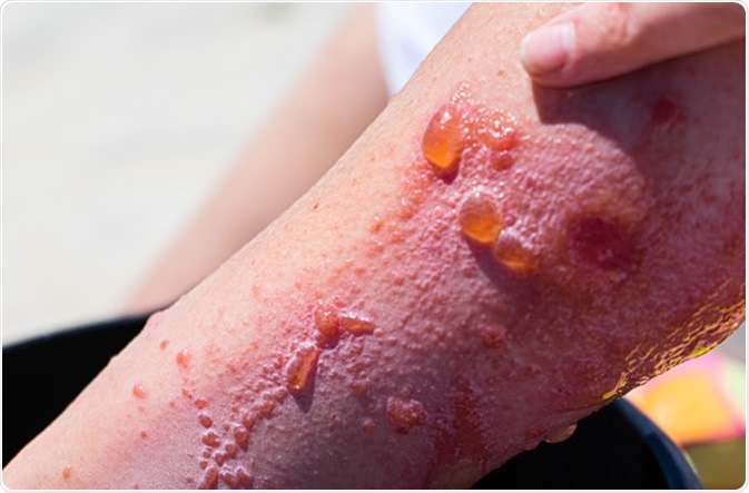 Pointing at severe allergic reaction to poison ivy on a woman