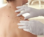How is Melanoma Diagnosed and Treated?