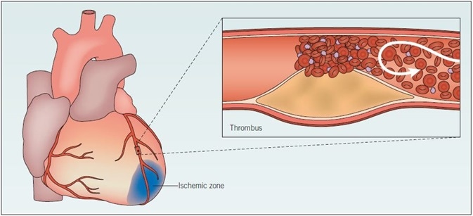 Myocardial infarction. When an atherosclerotic plaque ruptures, blood flow is greatly impeded, and thrombosis may occur. Consequently, the artery is occluded and the supply of oxygen to the heart is restricted. Ischemia results, and if it is sustained the heart muscle tissue may become damaged and die. The likelihood of plaque rupture is influenced by several factors, including elevated blood pressure and degree of inflammation. This damaged tissue does not function fully; acute myocardial ischemia results in ionic and metabolic disturbances that affect the membrane and action potentials of myocytes. Arrhythmias and heart failure may occur as a result of the slower conduction of electrical impulses.
