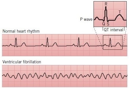 ECG traces of arrhythmia. Arrhythmias can be detected by electrocardiography (ECG or EKG), which measures the electrical activity of the heart. A normal ECG trace will have a consistent, regular form, representing the different intervals involved in cardiac rhythm. This includes the QT interval, during which the left and right ventricles depolarize and repolarize. During ventricular fibrillation, a type of arrhythmia, the heart does not contract in an ordered fashion; the absence of normal heart rhythm is apparent when comparing ECG traces.