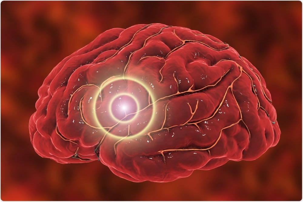 Ischemic stroke - abstract image