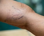 What are Varicose Veins and Can They be Treated?