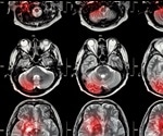 MRI shown to be a powerful tool in the detection and prevention of minor stroke