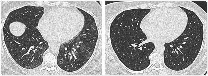 Axial unenhanced inspiratory CT images of the lungs in 51-year-old woman (a) before and (b) 6 months after bariatric surgery with 31-kg weight loss (body mass index decrease, 36.1%). The mosaic attenuation seen before surgery resolved after surgery.  Image Credit: Radiological Society of North America