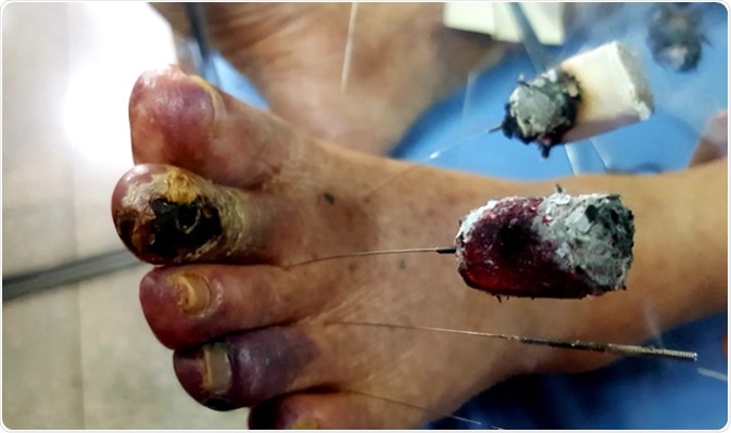 Mongolian medical warm acupuncture or moxibustion (burning mugwort over acupuncture points). Image Credit: Auraikan Sinlaparat / Shutterstock