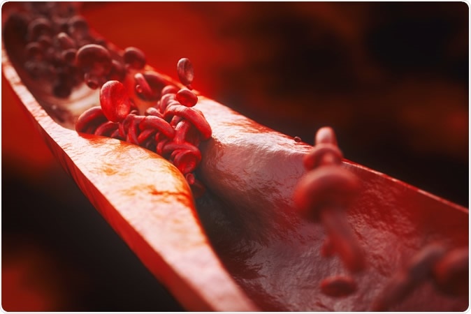 Closeup of a atherosclerosis- 3D rendering. Image Credit: Crevis / Shutterstock