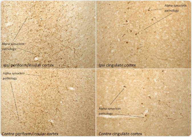 IHC analysis of rat brain injected with Type 1 mouse alpha synuclein PFFs (SPR-324) shows α-synucleinpathology.