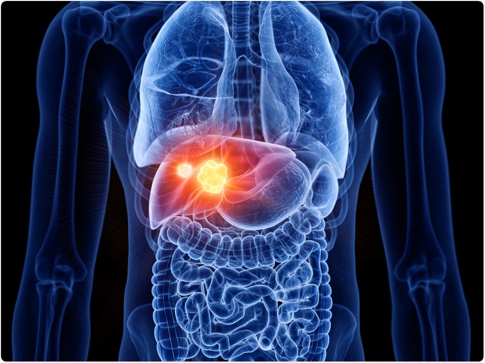 Liver Cancer