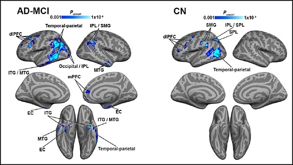 Impaired blood flow to brain regions linked with tau buildup in Alzheimer’s disease Impaired blood flow to brain regions linked with tau buildup in Alzheimer’s disease