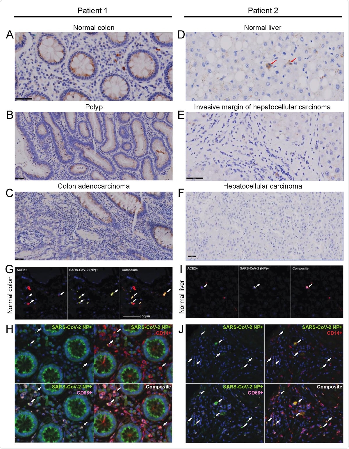 Immunohistochemical staining of the SARS-CoV-2 nucleocapsid protein in normal colon and liver tissue.
