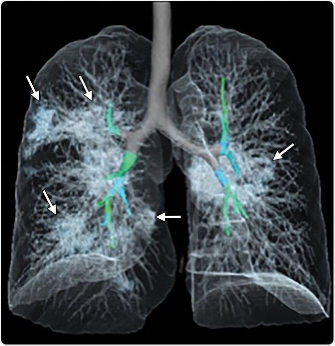 Images in a 41-year-old woman who presented with fever and positive polymerase chain reaction assay for the 2019 novel coronavirus (2019-nCoV). (a) Three representative axial thin-section chest CT images show multifocal ground glass opacities without consolidation. (b) Three-dimensional volume-rendered reconstruction shows the distribution of the ground-glass opacities (arrows). See also three-dimensional Movie (online).