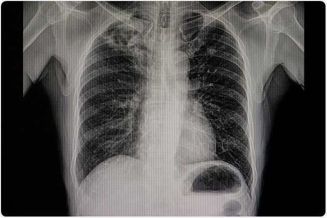 Xray film of a patient with active pulmonary tuberculosis with numerous cavitations and fibrotic change in the right upper lung. Infectious and contagious disease. TB communicable respiratory disease. Image Credit: Tomatheart / Shutterstock