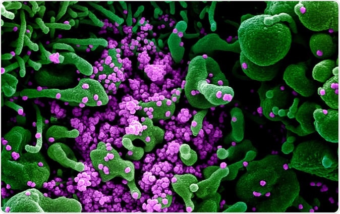 Novel Coronavirus SARS-CoV-2 Colorized scanning electron micrograph of an apoptotic cell (green) heavily infected with SARS-COV-2 virus particles (purple), isolated from a patient sample. Image captured and color-enhanced at the NIAID Integrated Research Facility (IRF) in Fort Detrick, Maryland. Credit: NIAID
