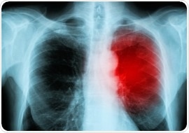 Cancer immunotherapy can lead to inflammation of the heart muscle