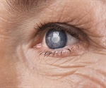 NEI researchers link age-related DNA modifications to susceptibility to eye disease