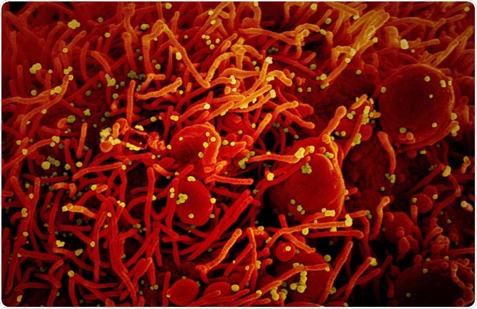Novel Coronavirus SARS-CoV-2 Colorized scanning electron micrograph of an apoptotic cell (red) infected with SARS-COV-2 virus particles (yellow), isolated from a patient sample. Image captured at the NIAID Integrated Research Facility (IRF) in Fort Detrick, Maryland. Credit: NIAID