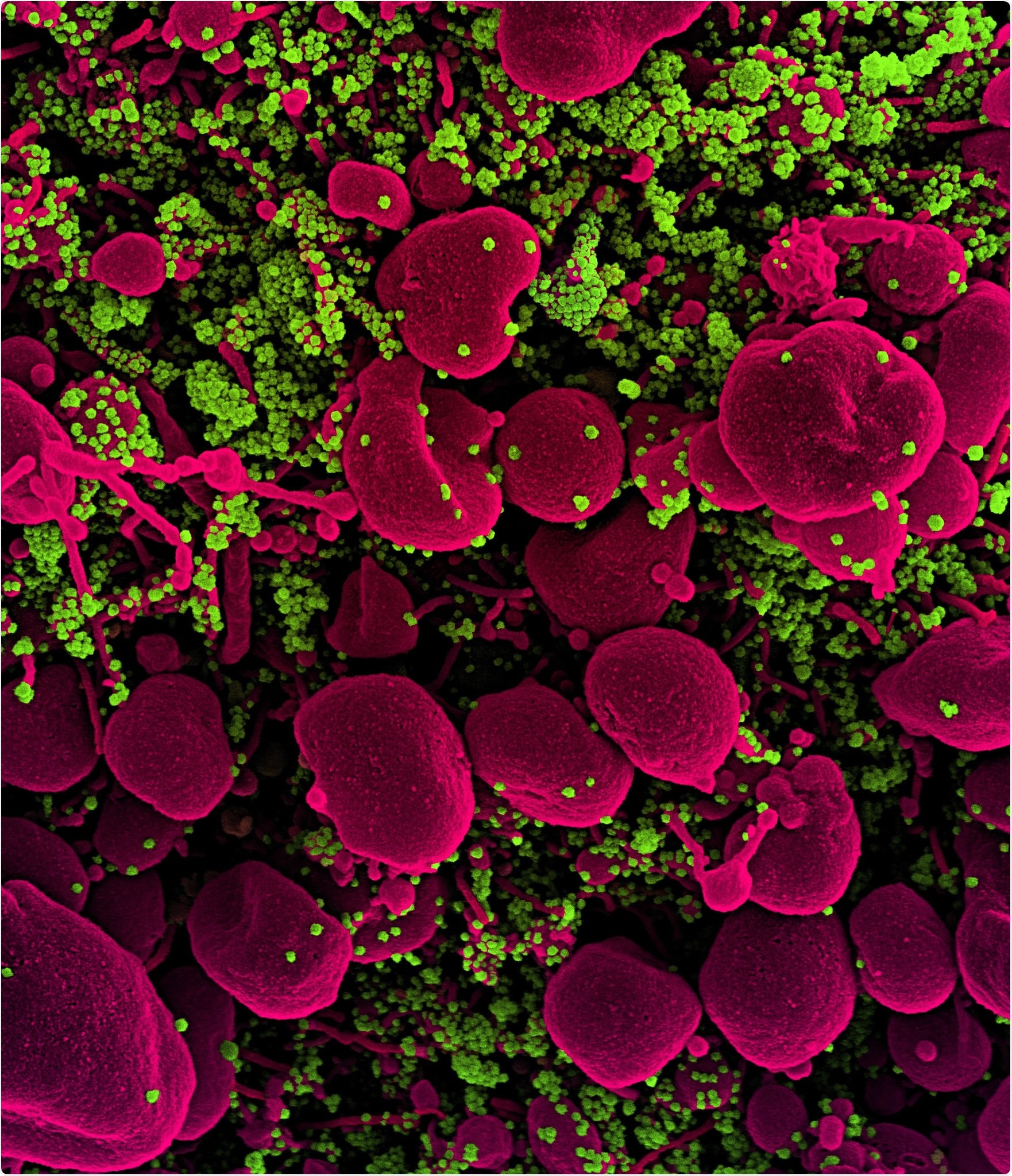 Novel Coronavirus SARS-CoV-2 Colorized scanning electron micrograph of an apoptotic cell (pink) heavily infected with SARS-COV-2 virus particles (green), isolated from a patient sample. Image captured at the NIAID Integrated Research Facility (IRF) in Fort Detrick, Maryland. Credit: NIAID