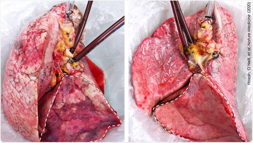 Human lung that failed on EVLP (left) and then recovered on cross-circulation (right).