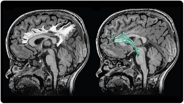 Prenatal depression influences child Prenatal depression influences child