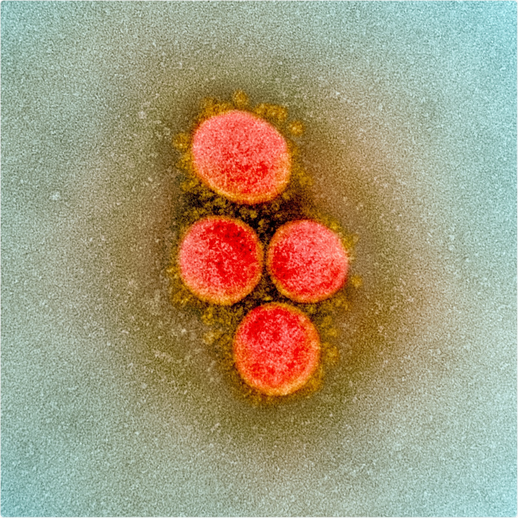 Transmission electron micrograph of SARS-CoV-2 virus particles, isolated from a patient. Image captured and color-enhanced at the NIAID Integrated Research Facility (IRF) in Fort Detrick, Maryland. Credit: NIAID