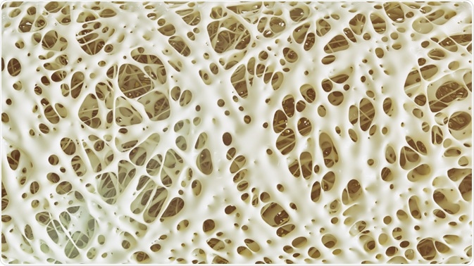 Osteoporosis