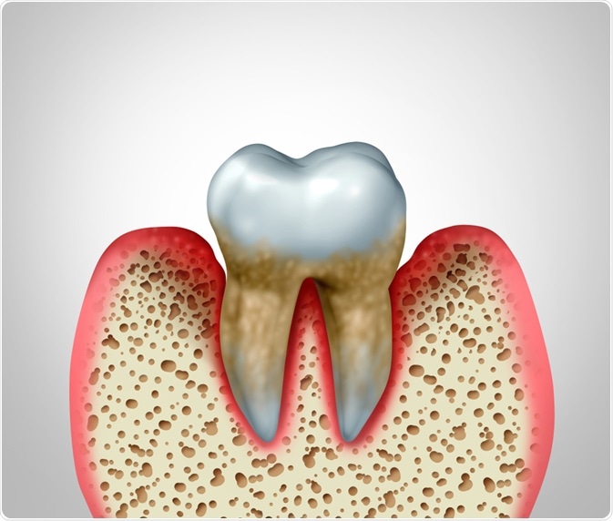 Periodontitis