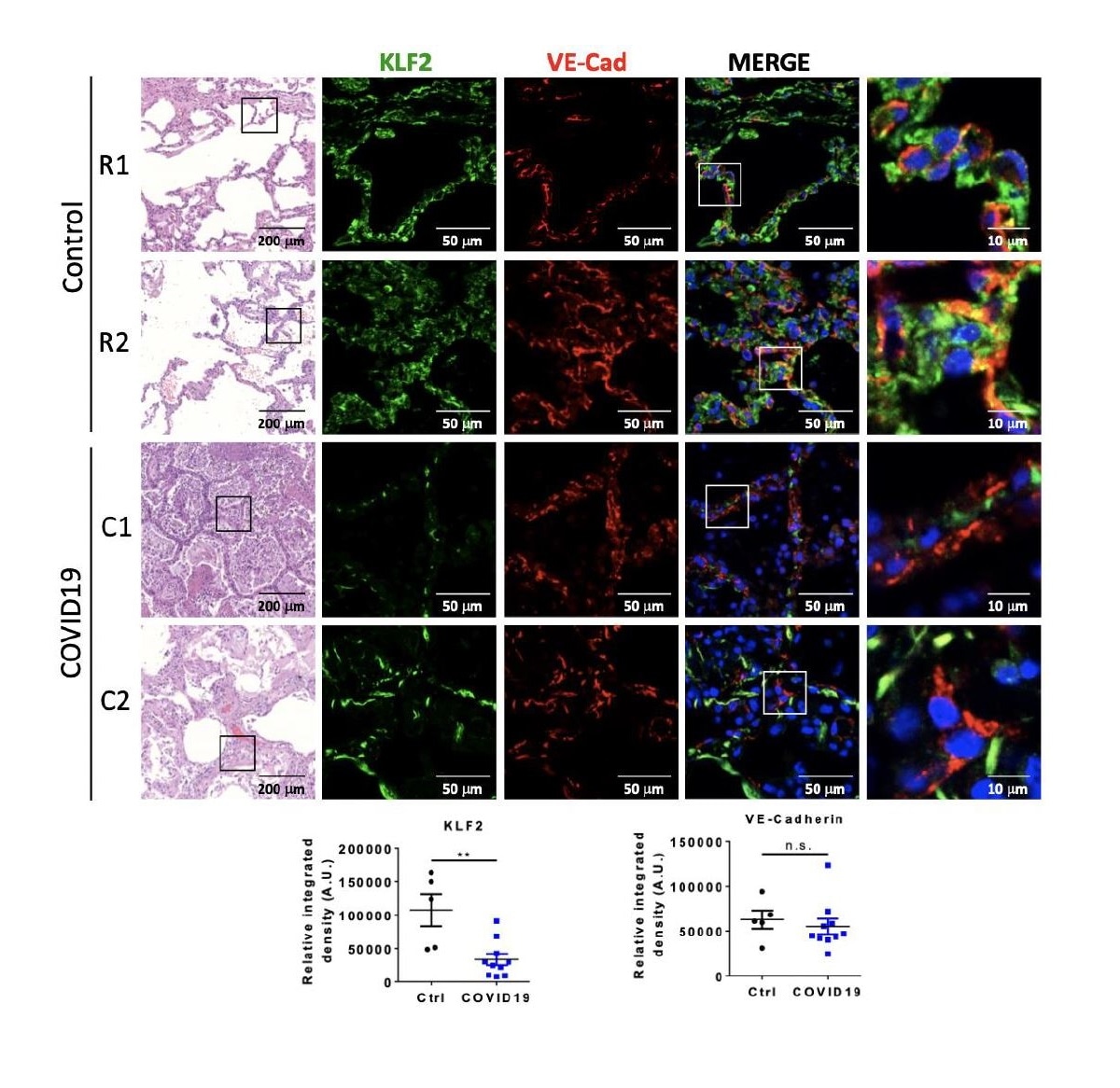Both ROBI (R#) and COVID-19 (C#) lung autopsy samples demonstrate distorted architecture on histology. Immunofluorescence is performed for KLF2 and VE-Cad, and quantified below. In ROBI lungs, KLF2 signal (green) co-localized with VE-Cad (red), which highlights pulmonary vasculature (n = 5). In COVID-19 samples, the KLF2 signal is significantly reduced when compared to ROBI lungs (p < 0.005, n = 10). There is no significant difference in VE-Cad between ROBI and COVID19 samples.