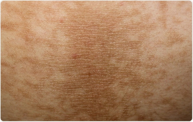 acanthosis nigrincans