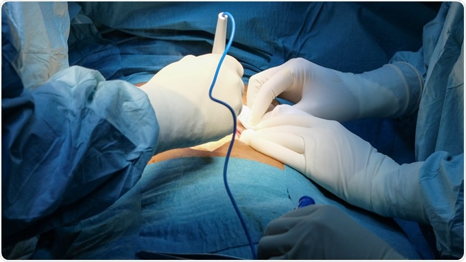 abdominal surgery