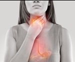What is Heartburn (Acid Reflux)?