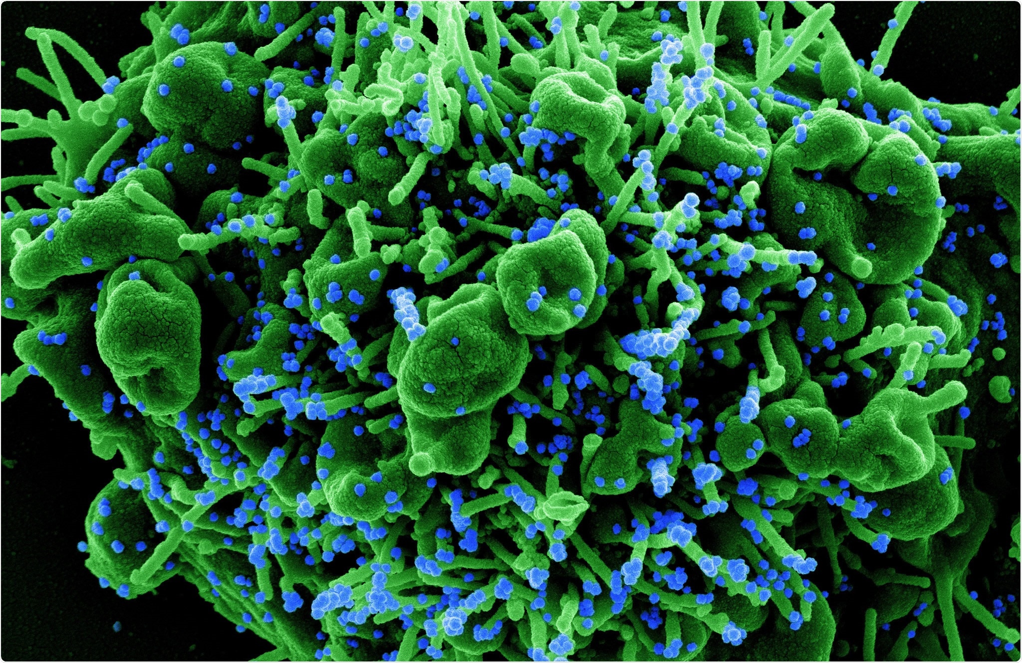 Study: Year-long COVID-19 infection reveals within-host evolution of SARS-CoV-2 in a patient with B cell depletion. Image Credit: NIAID