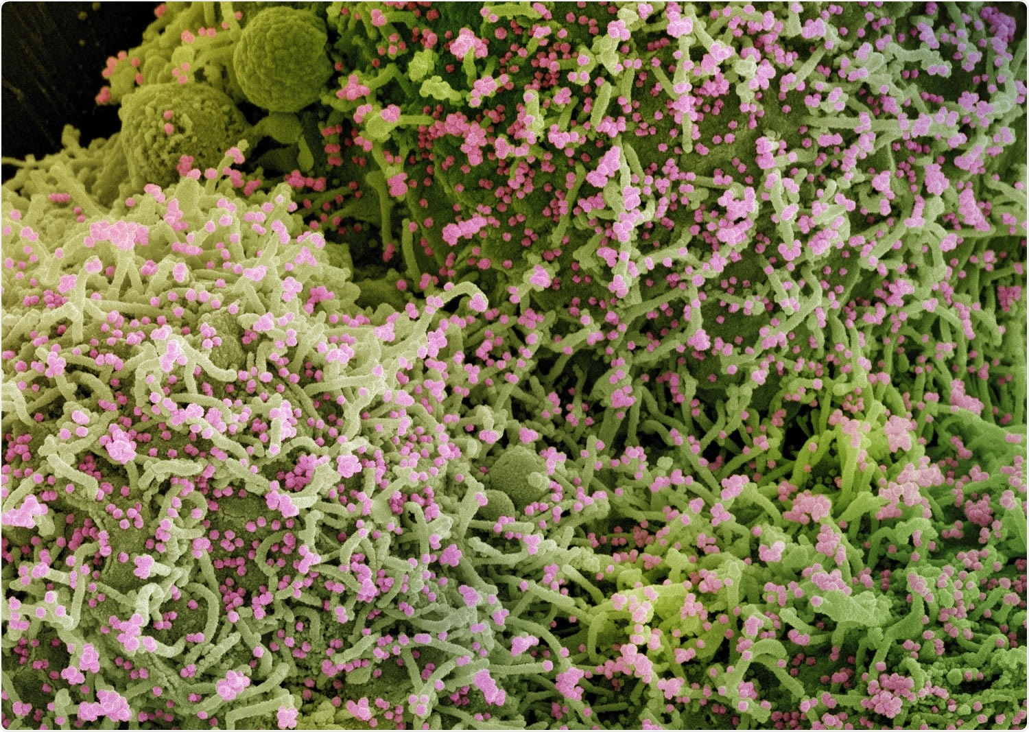 Study: COVID-19 is associated with higher risk of venous thrombosis, but not arterial thrombosis, compared with influenza: Insights from a large US cohort. Image Credit: NIAID