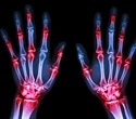Smart material delivers drugs in response to arthritis flare-ups