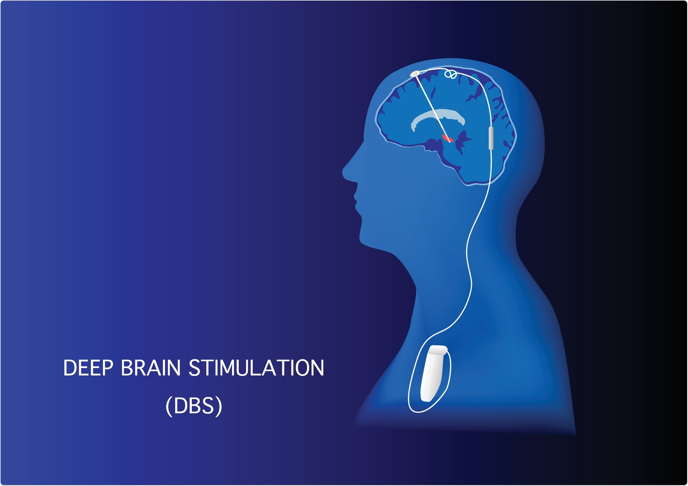 Deep Brain Stimulation