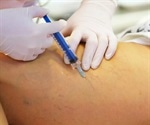 Using foam sclerotherapy to treat underlying vein conditions