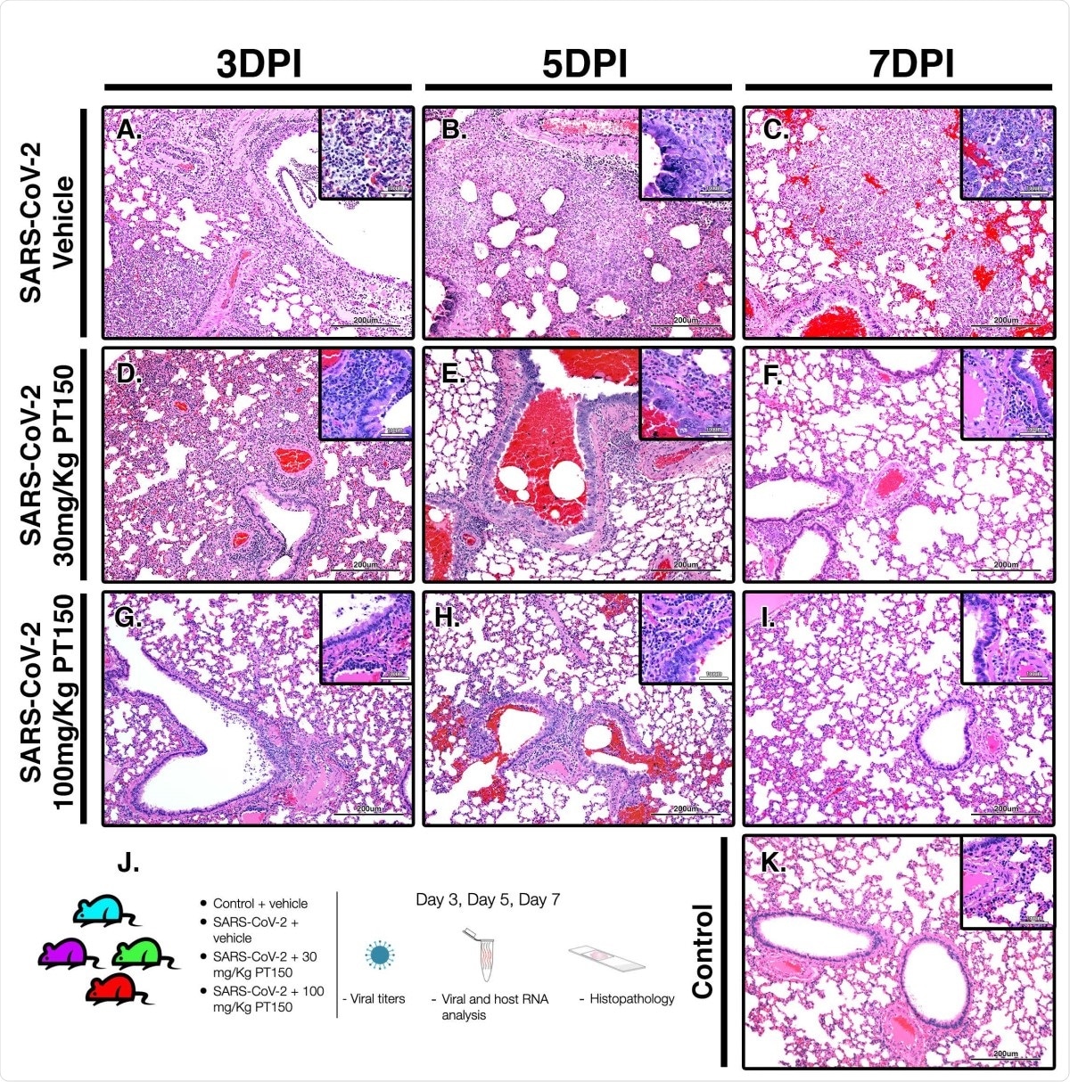 PT150 protects against adverse histopathological outcomes in the lungs of Syrian hamsters infected with SARS-CoV-2. Hamsters were infected by intranasal inoculation with 2.5 × 104 TCID50/ml equivalents of SARS-CoV-2 (strain 2019-nCoV/USA-WA1/ 2020) and lung tissue was stained with hematoxylin and eosin (H&E) for examination of pathological changes on days 3, 5 and 7 post-infection. Treatment groups were (A-C) SARS-CoV-2 + vehicle, (D-F), SARS-CoV-2 + 30 mg/Kg/day PT150, (G-I) SARS-CoV-2 + 100 mg/Kg/day PT150 and (J) Control + vehicle.